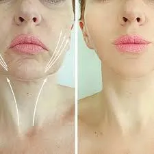 Hilos tensores y tratamientos faciales: estética discreta y natural